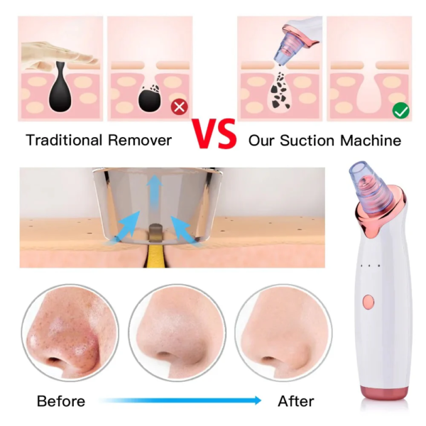 Blackhead Vacuum Pore Cleaner Blackhead Remover - Image 5